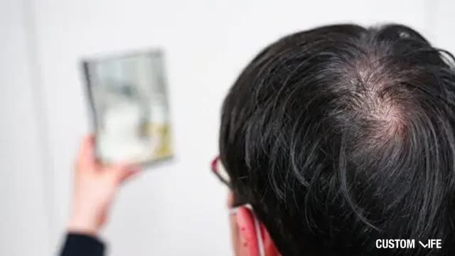 薄毛治療をしている男性の頭皮