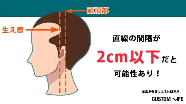 M字ハゲ診断基準