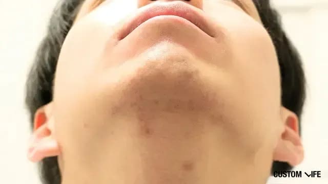 メンズリゼで脱毛したあご下レーザー脱毛後