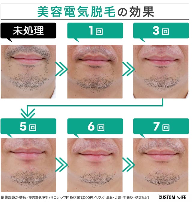 編集部員が実際に体験した美容電気脱毛のヒゲ脱毛10回目までのビフォーアフター