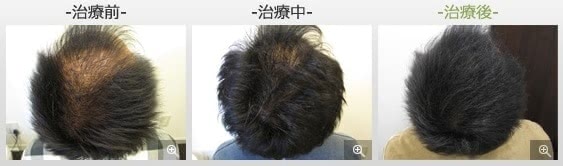 銀クリのAGA治療効果