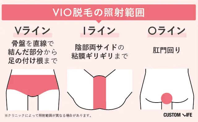 VIO脱毛の照射範囲