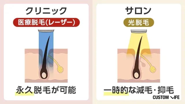 クリニックは永久脱毛、サロンは減耗や抑毛ができるイラスト