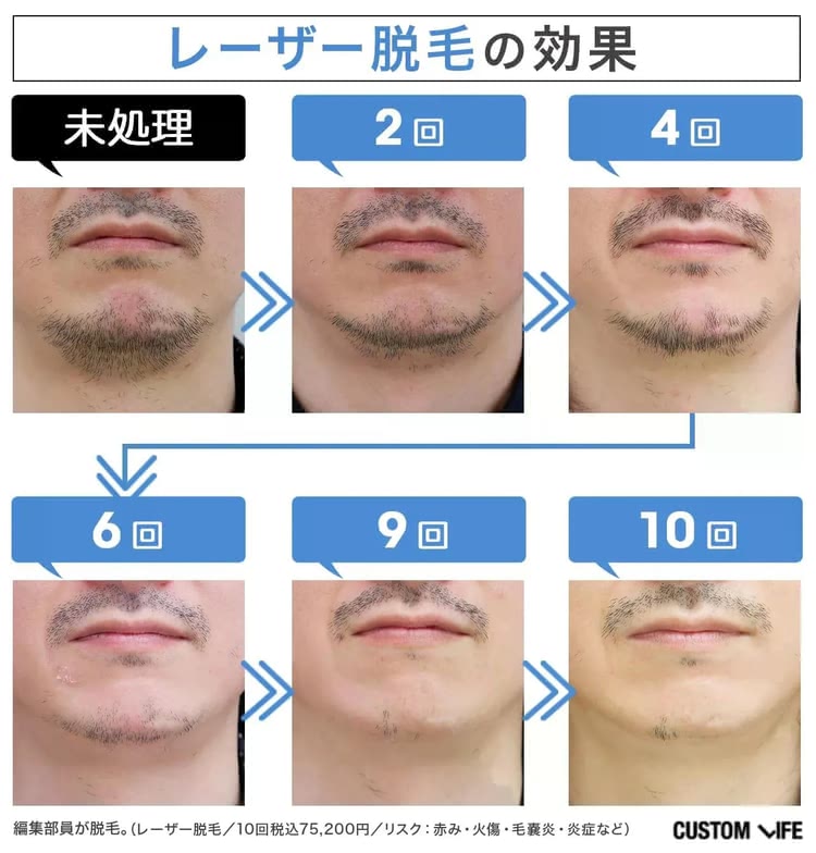 編集部がヒゲの医療脱毛で効果を検証