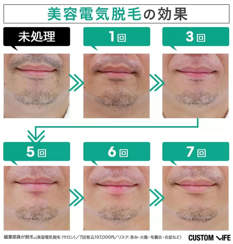 編集部ヒゲの美容電気脱毛0回から7回効果ビフォーアフター