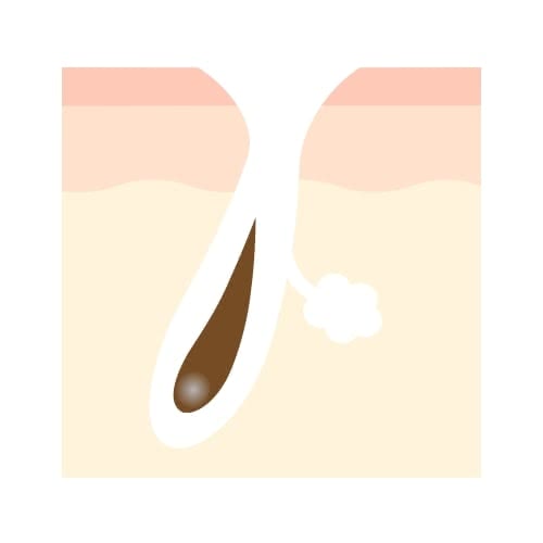 開いた毛穴