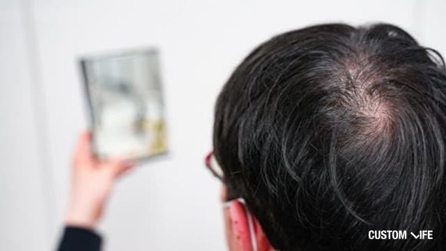 AGA・薄毛に悩む男性