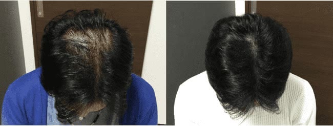 AGAメディカルケアクリニックのAGA治療効果