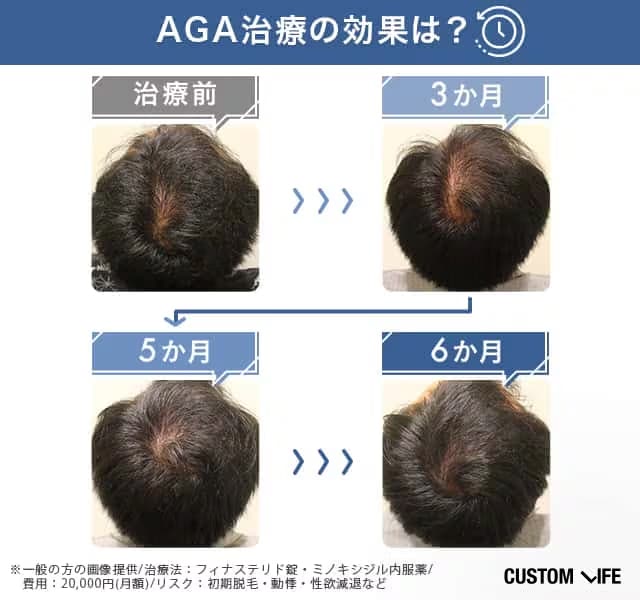 AGA治療の効果を編集部が実証