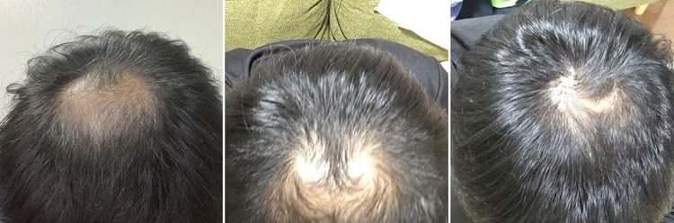 クリニックフォアのAGA治療効果