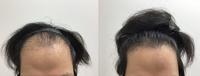 AGAオンラインクリニックのAGA治療効果