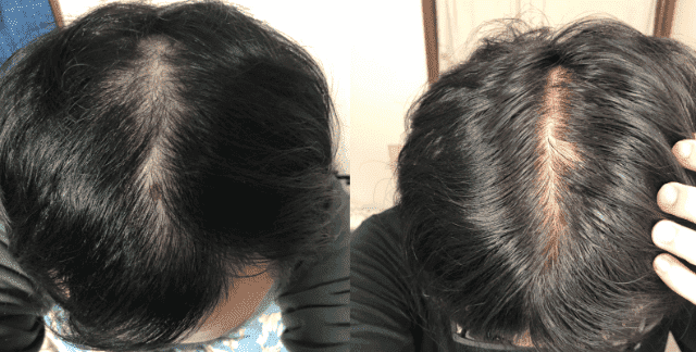 Hair's オンライン・ヘアウェルネスサービスのAGA治療効果
