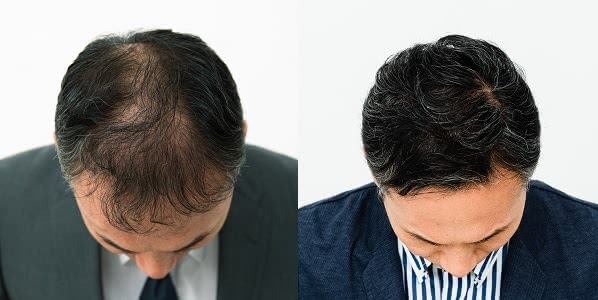 イースト駅前クリニックのAGA治療効果
