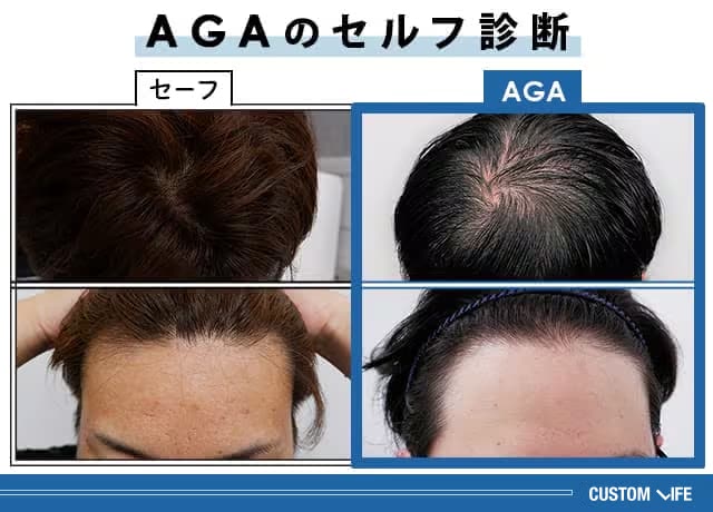 AGAのセルフ診断方法