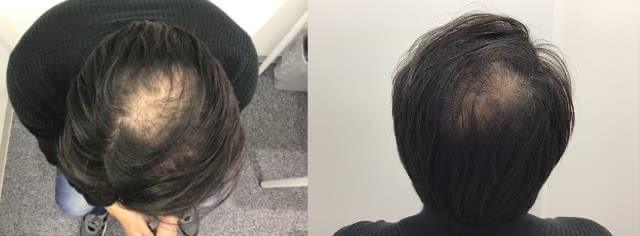 AGA治療前の男性の頭部