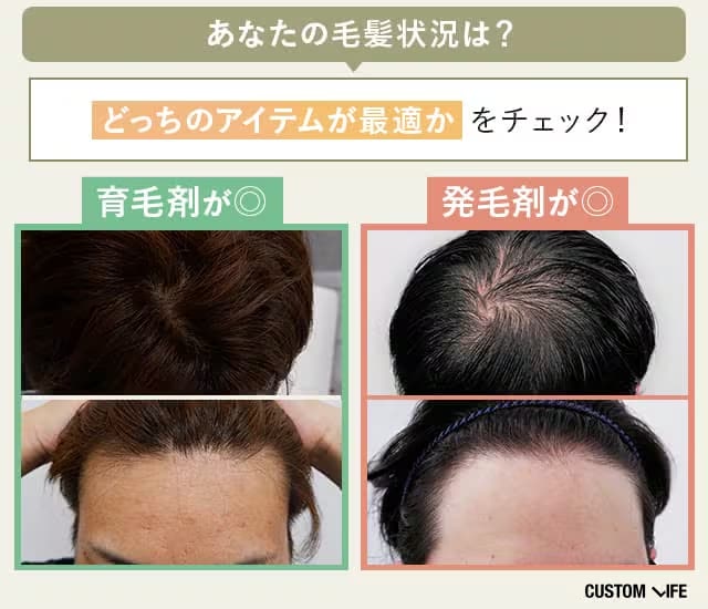 育毛剤と発毛剤は現在の頭皮状況から選ぶ