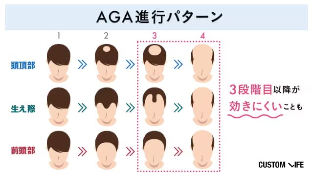 症状が進むにつれて効果を実感しにくいことを表すイラスト