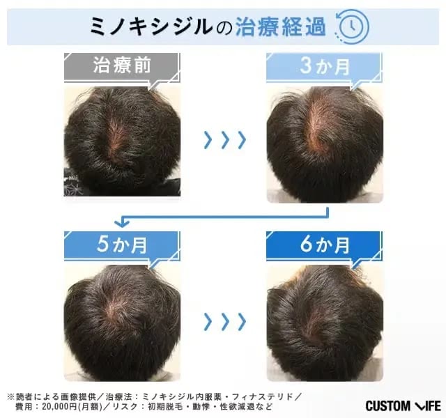 ミノキシジルで発毛治療した経験者の経過画像