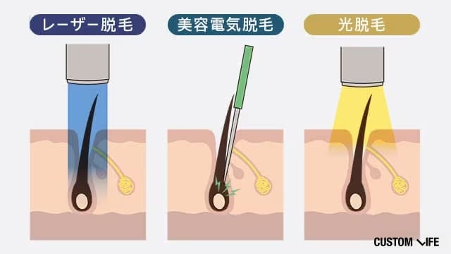 脱毛方法による特徴や違い