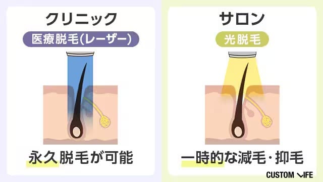 サロンとクリニックの脱毛方式の違いをまとめた画像